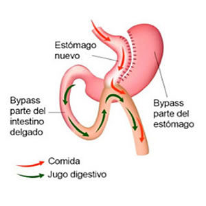 endocrinos en santa cruz Dra. Mónica Vera - Cirugia de Obesidad - Cirugia Bariátrica en Santa Cruz - Bolivia